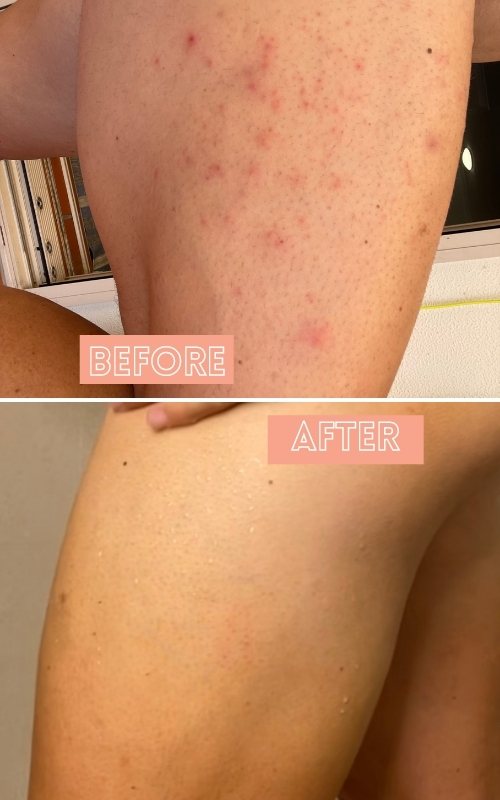Got rid of ingrowns and pimples